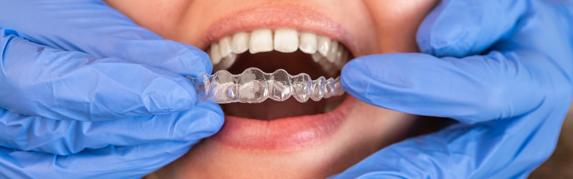 Know About Pros and Cons of Invisalign Braces